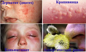 Киев для детей от аллергии thumbnail